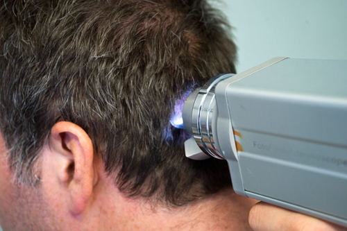 Eine Kopfhaut wird mit Hilfe eines speziellen Geräts untersucht